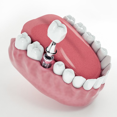 Render of dental implant in Jersey City, NJ with abutment and crown