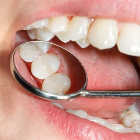 Closeup of smile with composite resin fillings