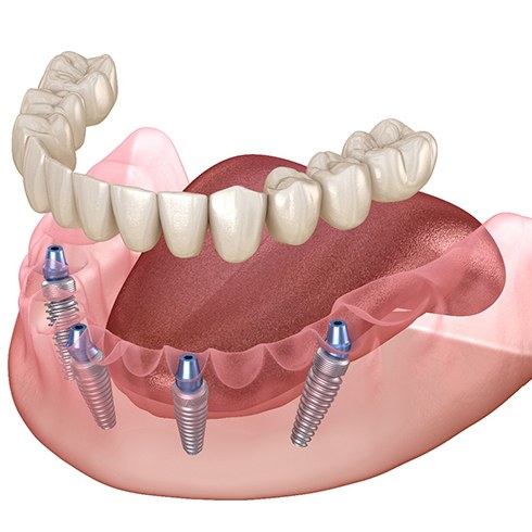 Illustration of an implant denture in Jersey City, NJ