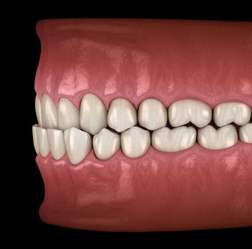 Side view illustration of an underbite against dark background