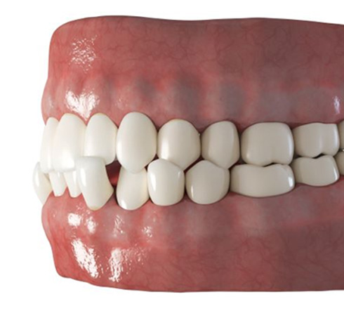 Three-dimensional illustration of a crossbite