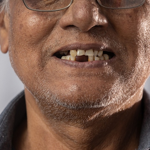 A closeup of an older man with missing teeth