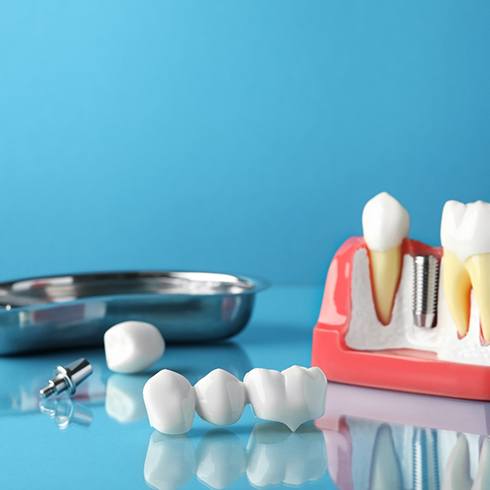 Dental implant and dental bridge parts set against a blue background